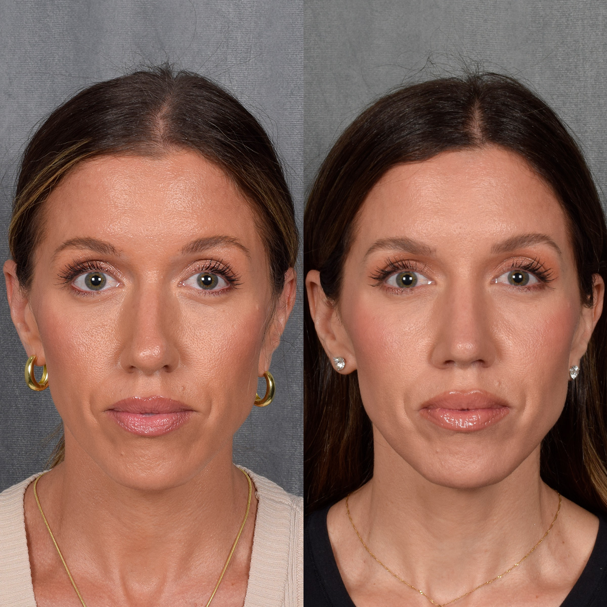 Rhinoplasty Before & After Gallery - Patient 177555 - Image 4