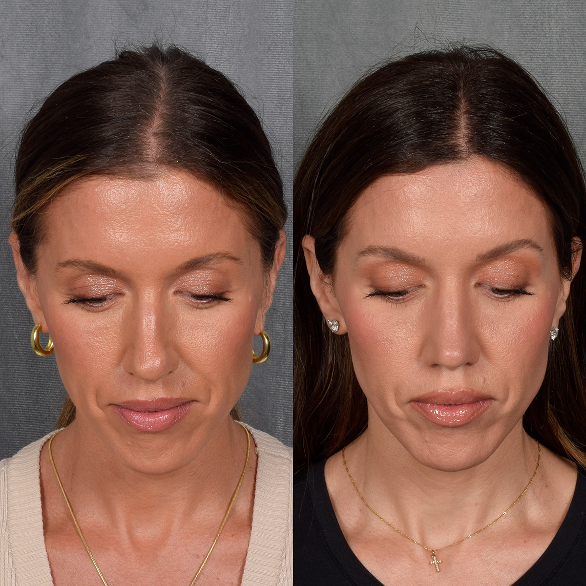 Rhinoplasty Before & After Gallery - Patient 177555 - Image 6