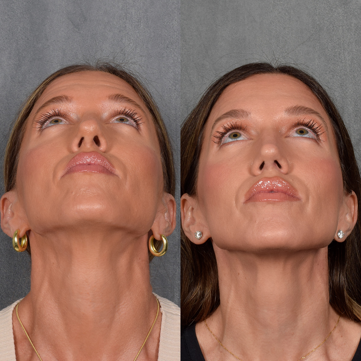 Rhinoplasty Before & After Gallery - Patient 177555 - Image 5