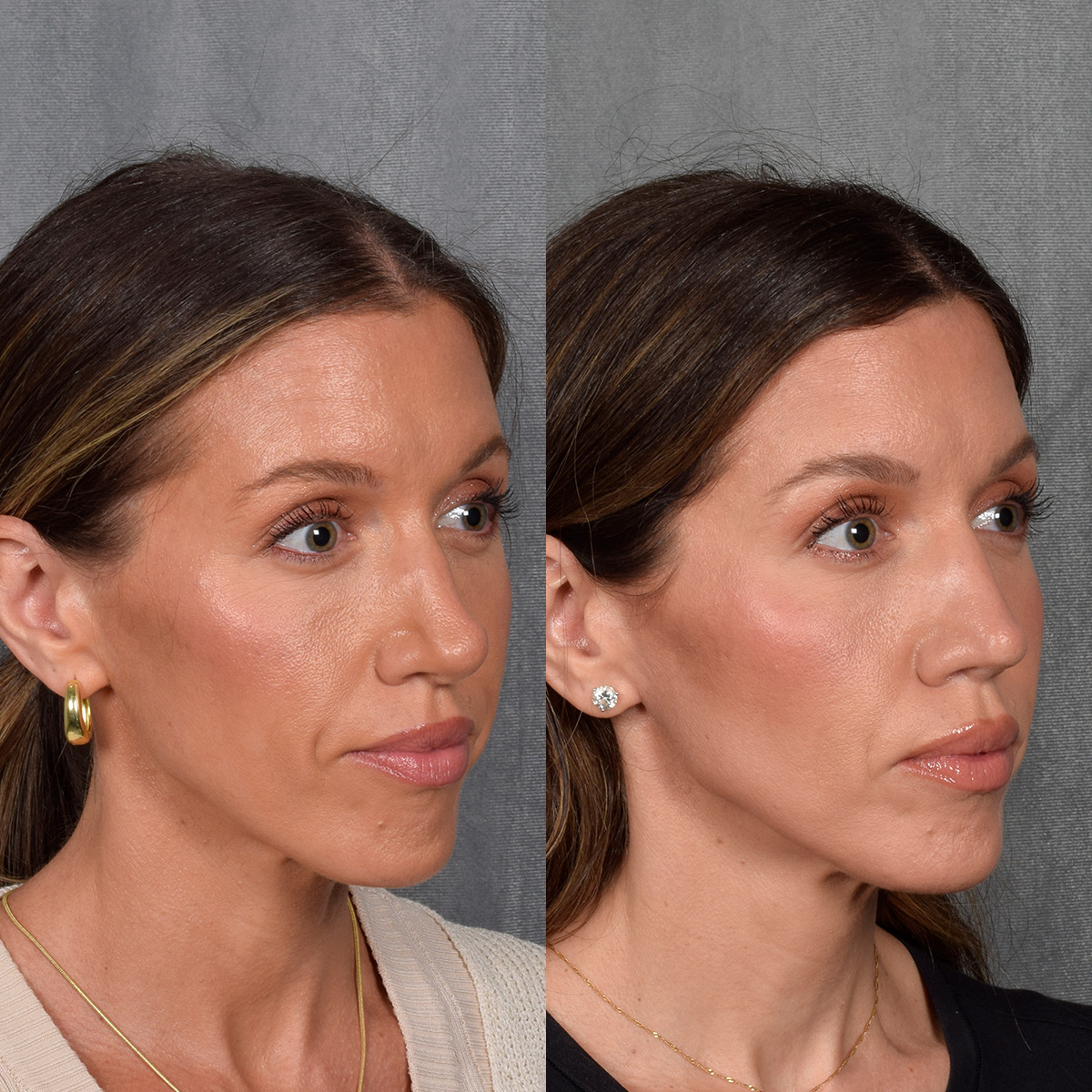 Rhinoplasty Before & After Gallery - Patient 177555 - Image 7