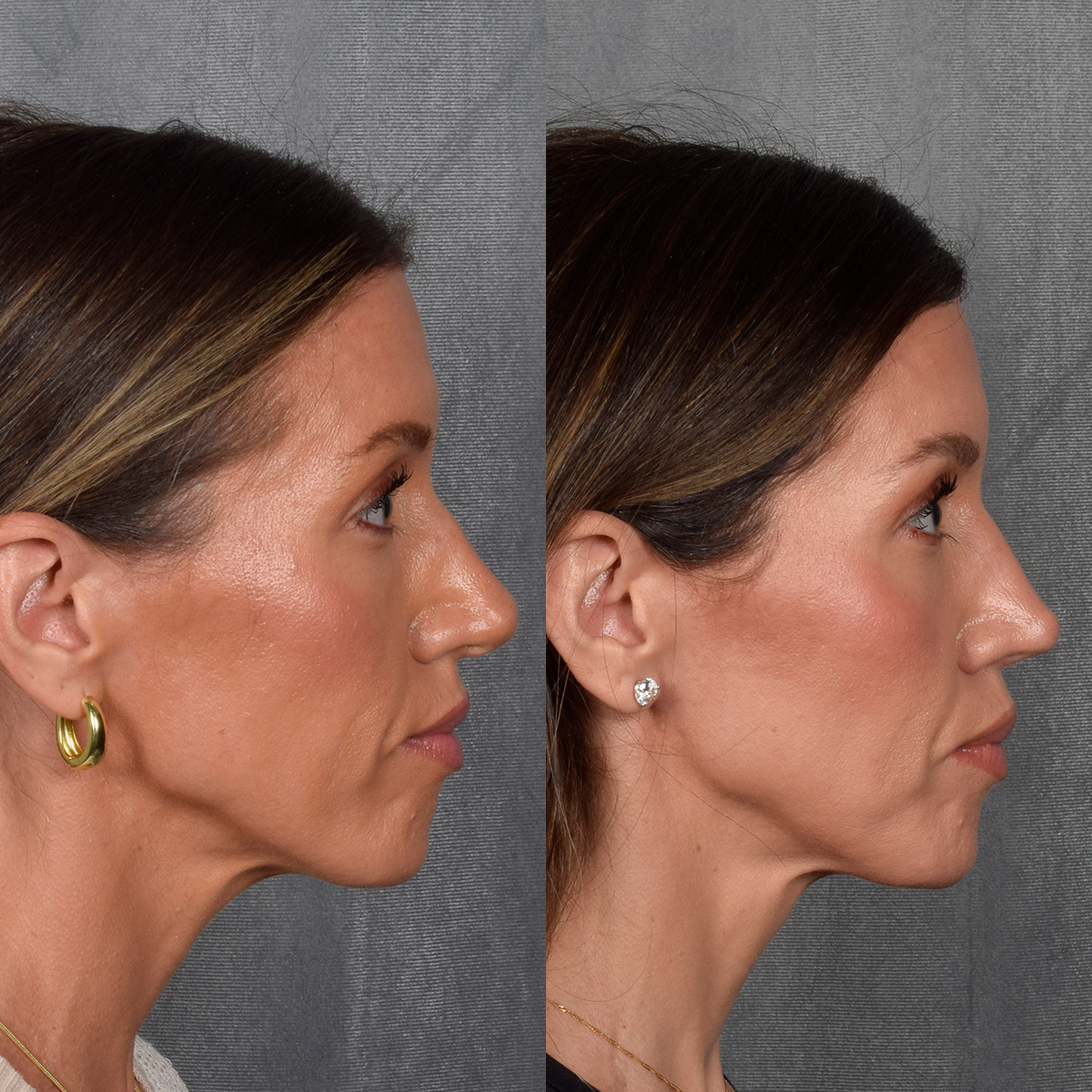 Rhinoplasty Before & After Gallery - Patient 177555 - Image 9