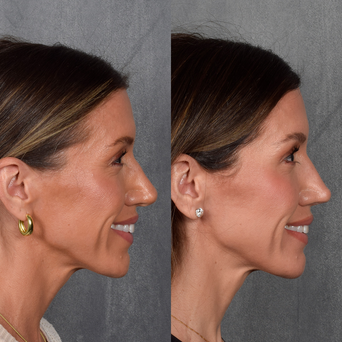 Rhinoplasty Before & After Gallery - Patient 177555 - Image 8