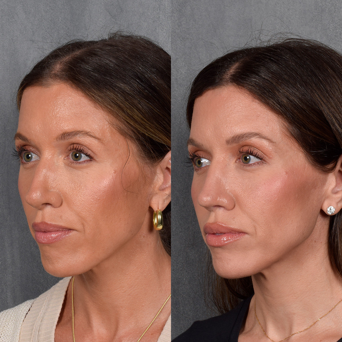 Rhinoplasty Before & After Gallery - Patient 177555 - Image 3