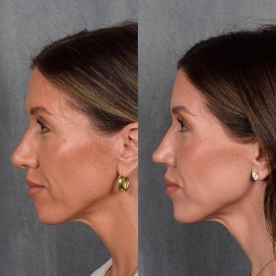 Rhinoplasty Before & After Gallery - Patient 177555 - Image 1