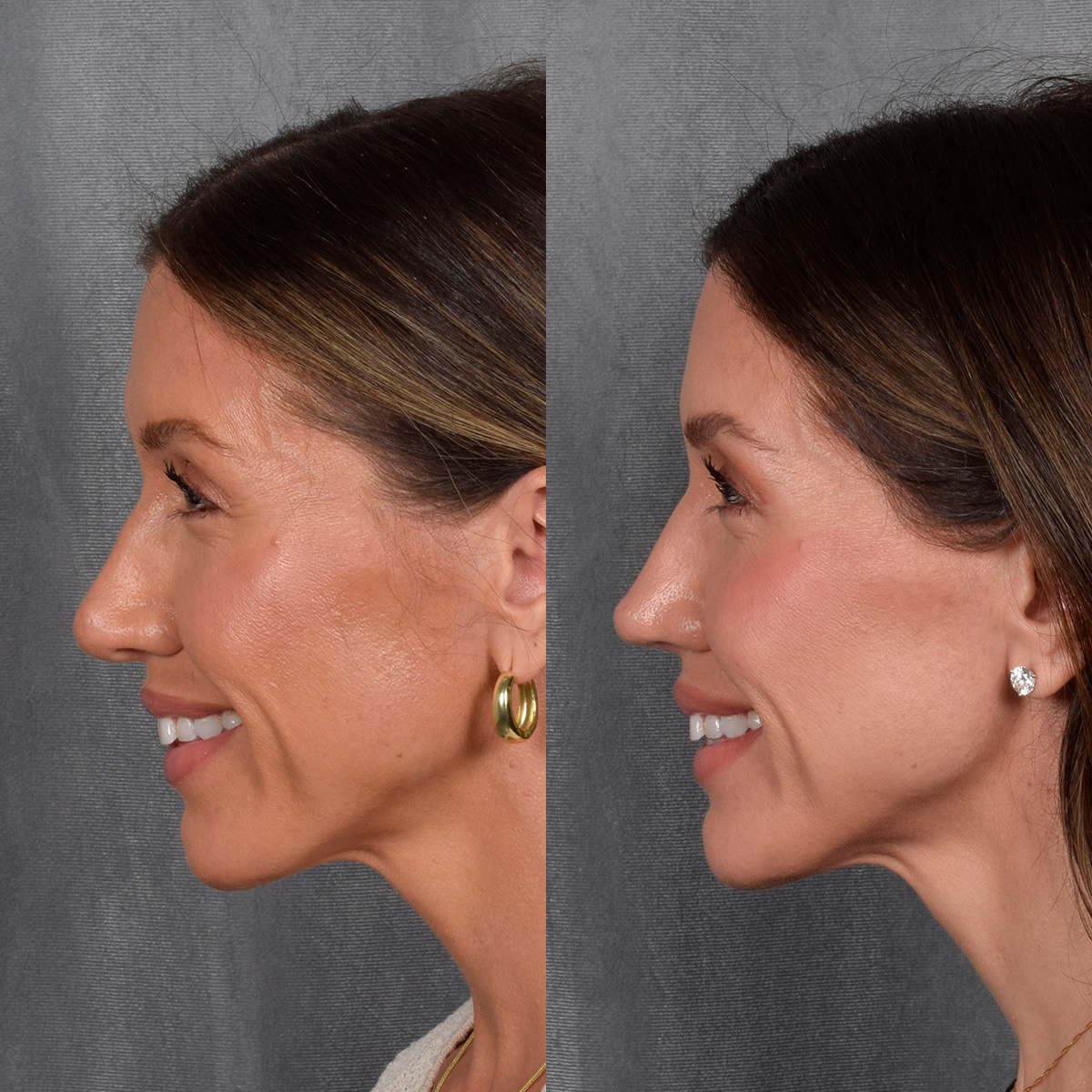 Rhinoplasty Before & After Gallery - Patient 177555 - Image 2