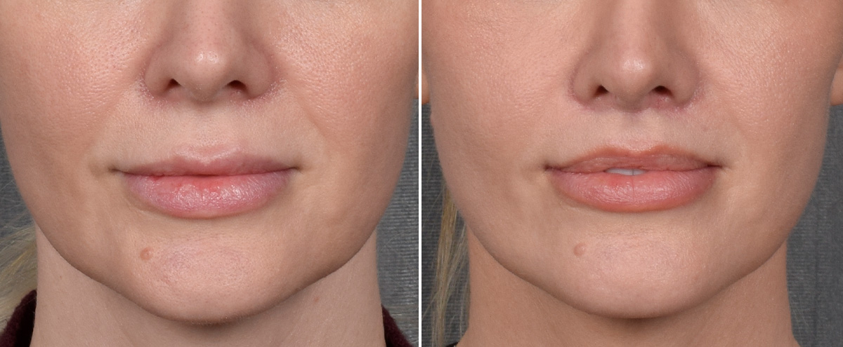 Lip Lift Before & After Gallery - Patient 290138 - Image 1