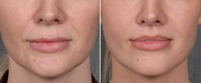 Lip Lift Before & After Gallery - Patient 290138 - Image 1