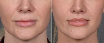 Lip Lift Before & After Gallery - Patient 290138 - Image 1