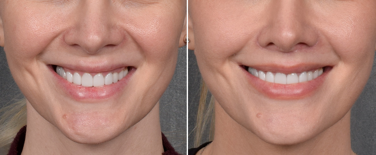 Lip Lift Before & After Gallery - Patient 290138 - Image 2