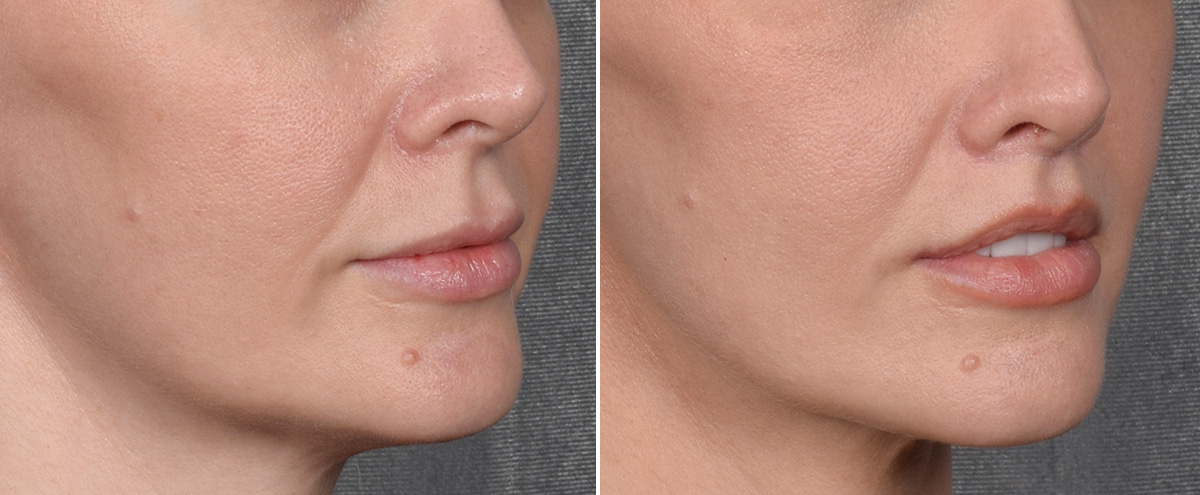 Lip Lift Before & After Gallery - Patient 290138 - Image 3