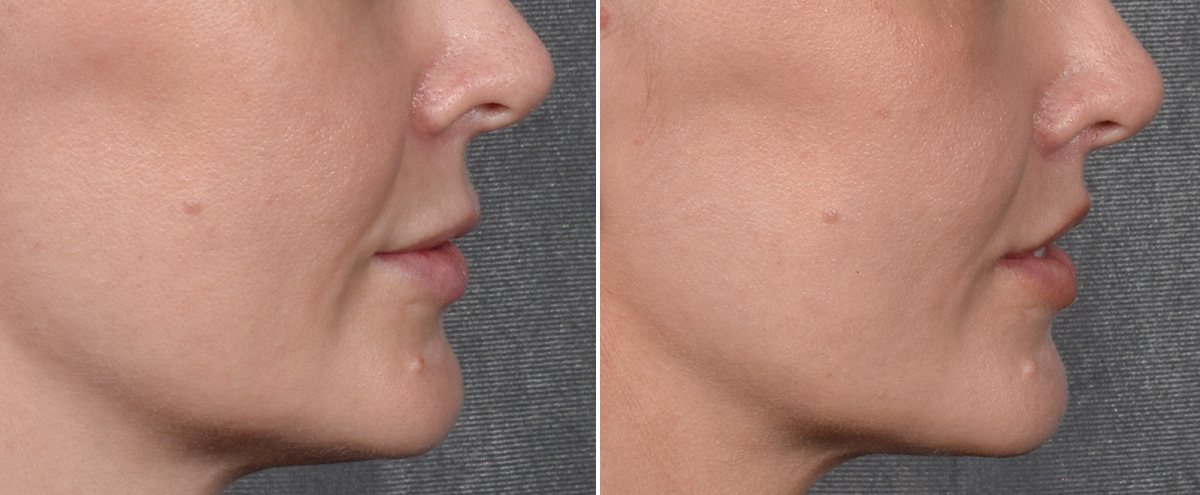 Lip Lift Before & After Gallery - Patient 290138 - Image 4