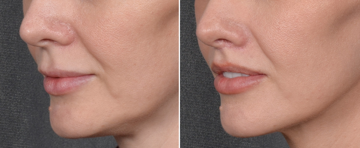 Lip Lift Before & After Gallery - Patient 290138 - Image 5