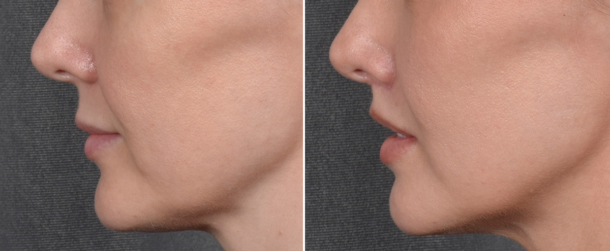Lip Lift Before & After Gallery - Patient 290138 - Image 6