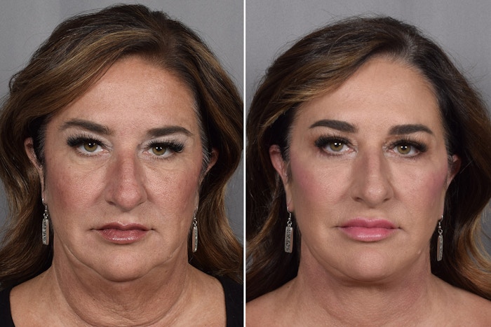 Facelift Before & After Gallery - Patient 265637 - Image 1