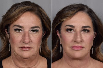 Facelift Before & After Gallery - Patient 265637 - Image 1