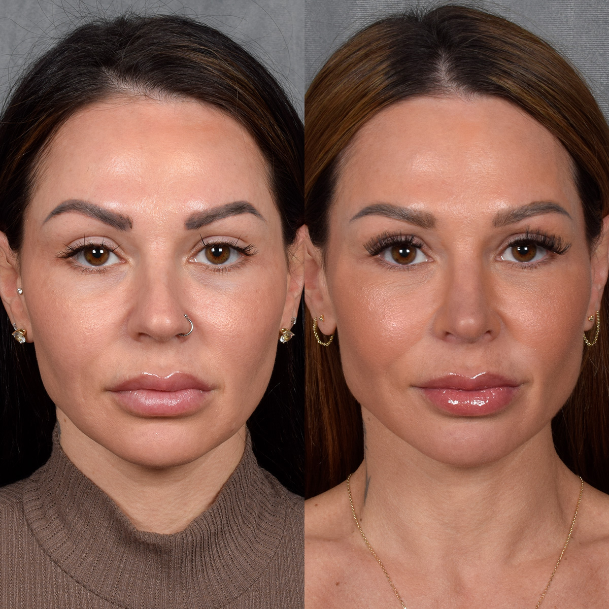 Rhinoplasty Before & After Gallery - Patient 267488 - Image 4