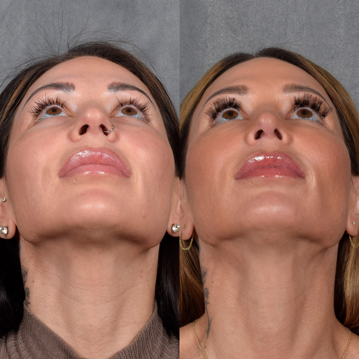 Rhinoplasty Before & After Gallery - Patient 267488 - Image 5