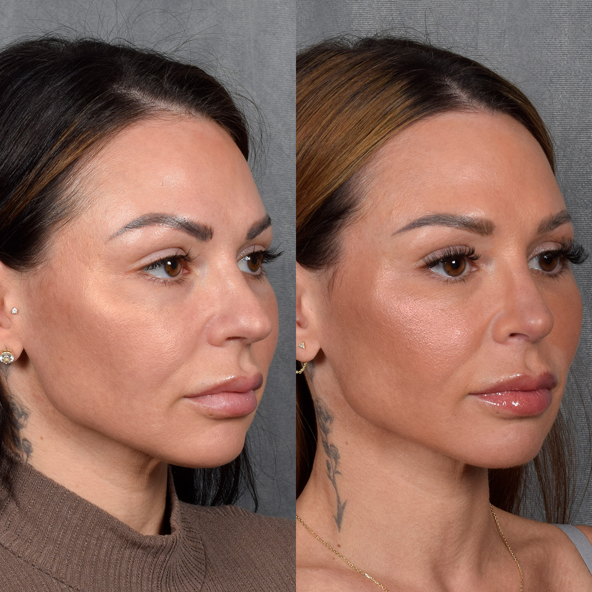 Rhinoplasty Before & After Gallery - Patient 267488 - Image 6