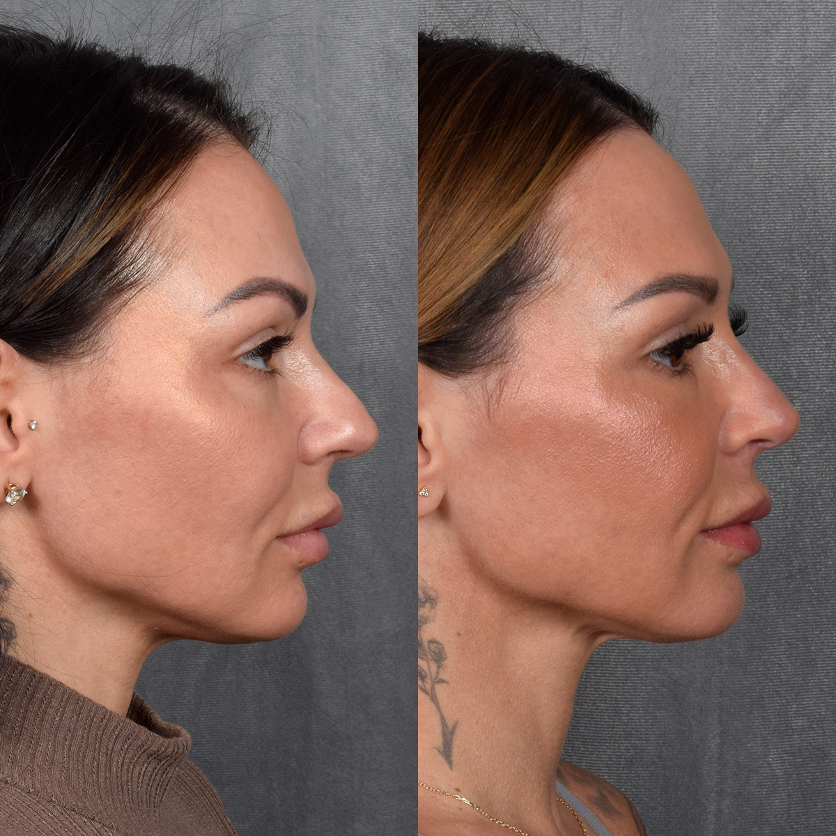 Rhinoplasty Before & After Gallery - Patient 267488 - Image 8