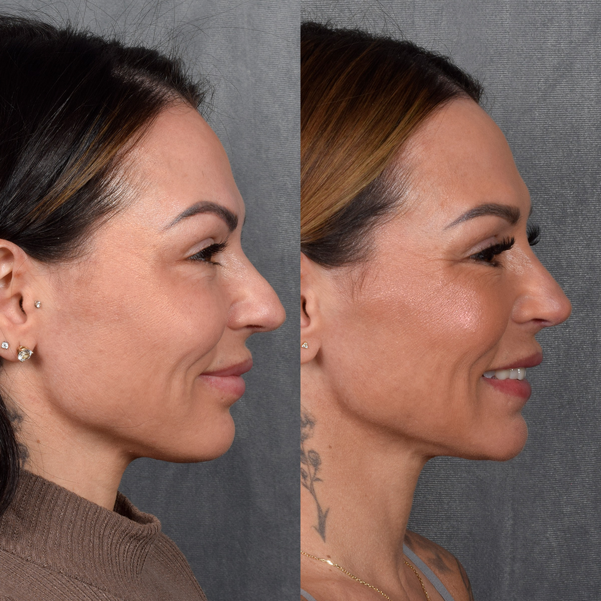 Rhinoplasty Before & After Gallery - Patient 267488 - Image 7