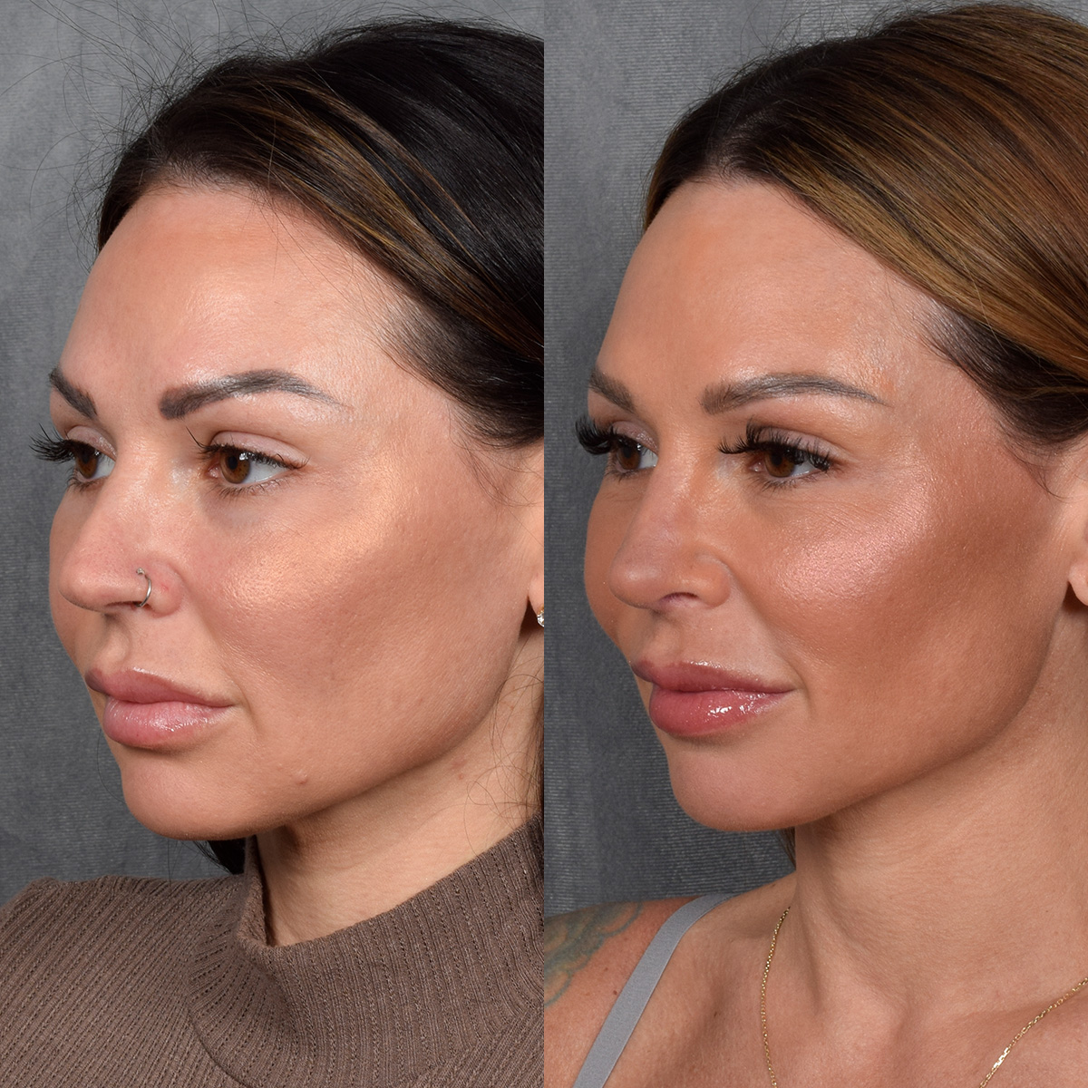 Rhinoplasty Before & After Gallery - Patient 267488 - Image 3