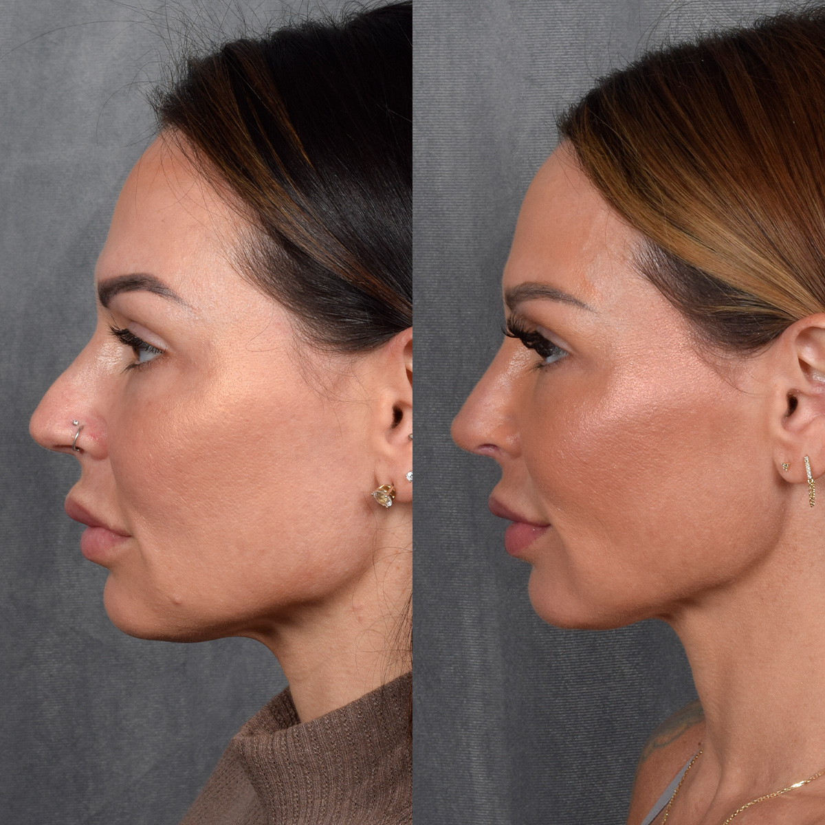 Rhinoplasty Before & After Gallery - Patient 267488 - Image 1
