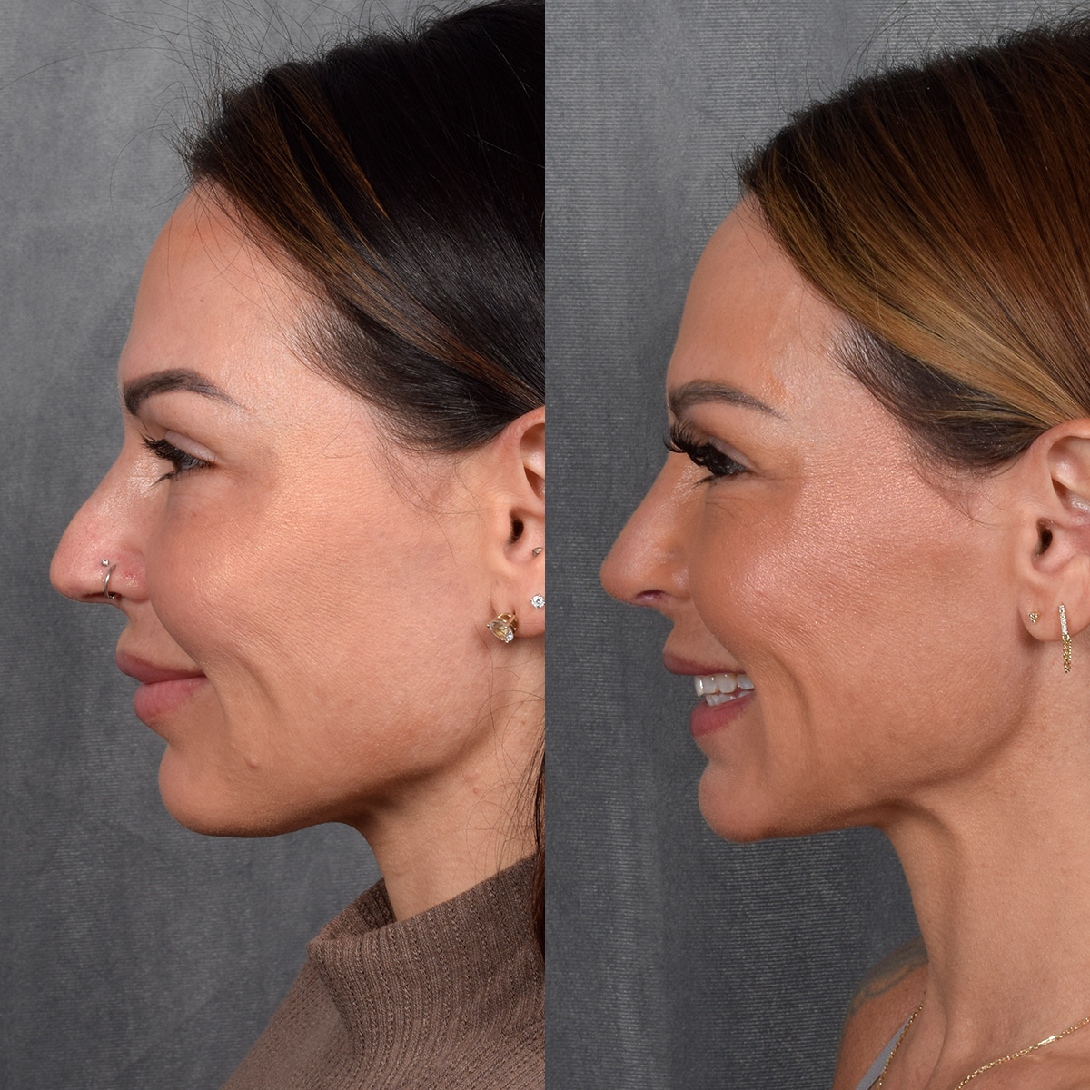 Rhinoplasty Before & After Gallery - Patient 267488 - Image 2