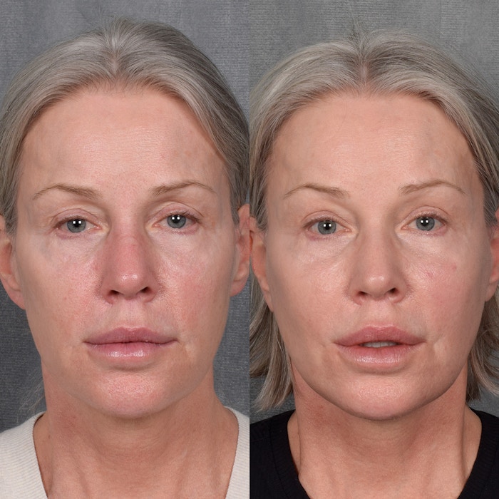 Facelift Before & After Gallery - Patient 171995 - Image 1