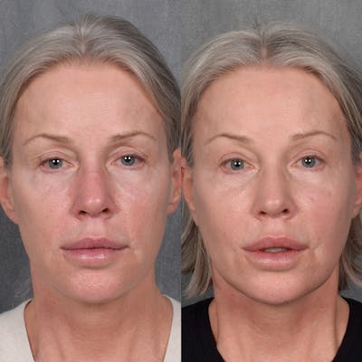 Facelift Before & After Gallery - Patient 171995 - Image 1