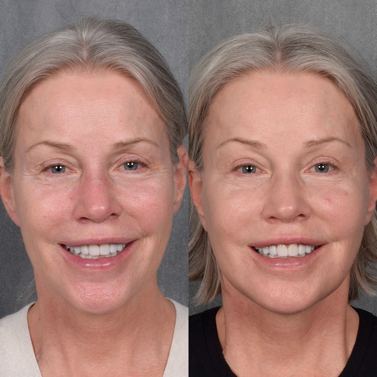 Facelift Before & After Gallery - Patient 171995 - Image 2
