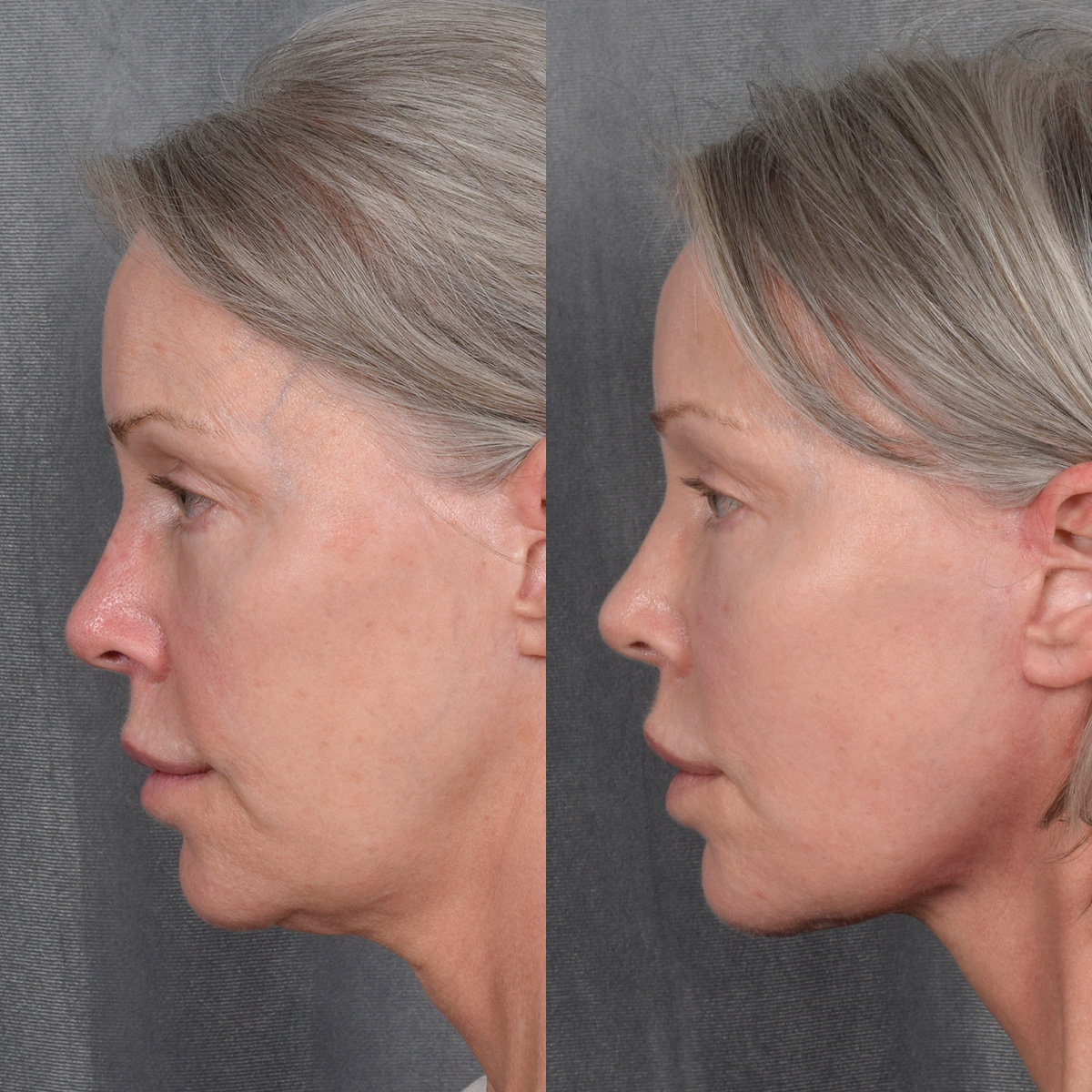 Facelift Before & After Gallery - Patient 171995 - Image 5