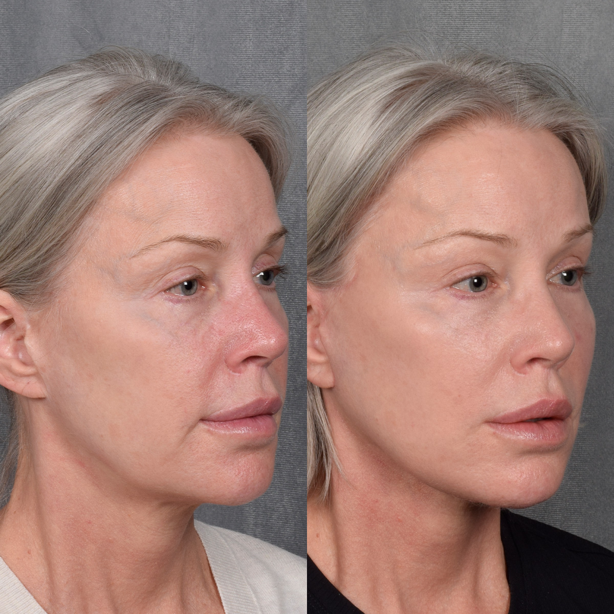 Facelift Before & After Gallery - Patient 171995 - Image 3