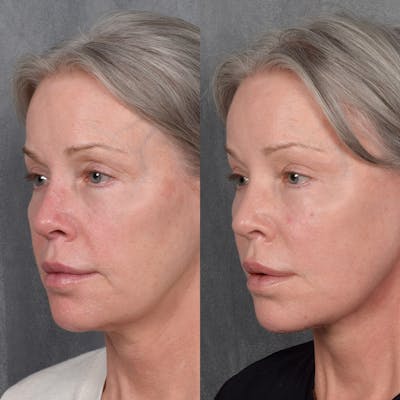 Facelift Before & After Gallery - Patient 171995 - Image 1