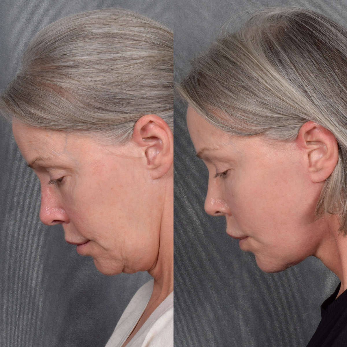 Facelift Before & After Gallery - Patient 171995 - Image 6