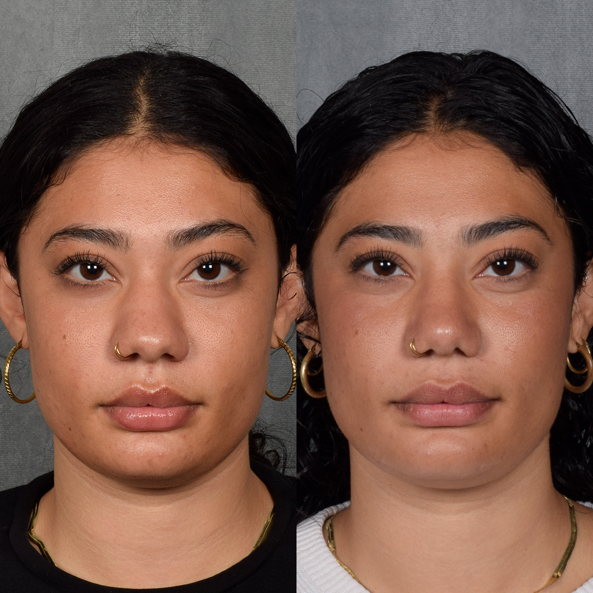 Rhinoplasty Before & After Gallery - Patient 258679 - Image 4