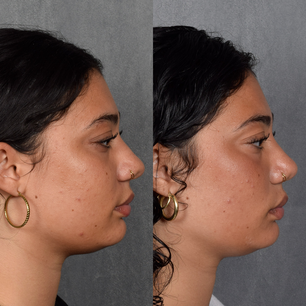 Rhinoplasty Before & After Gallery - Patient 258679 - Image 7