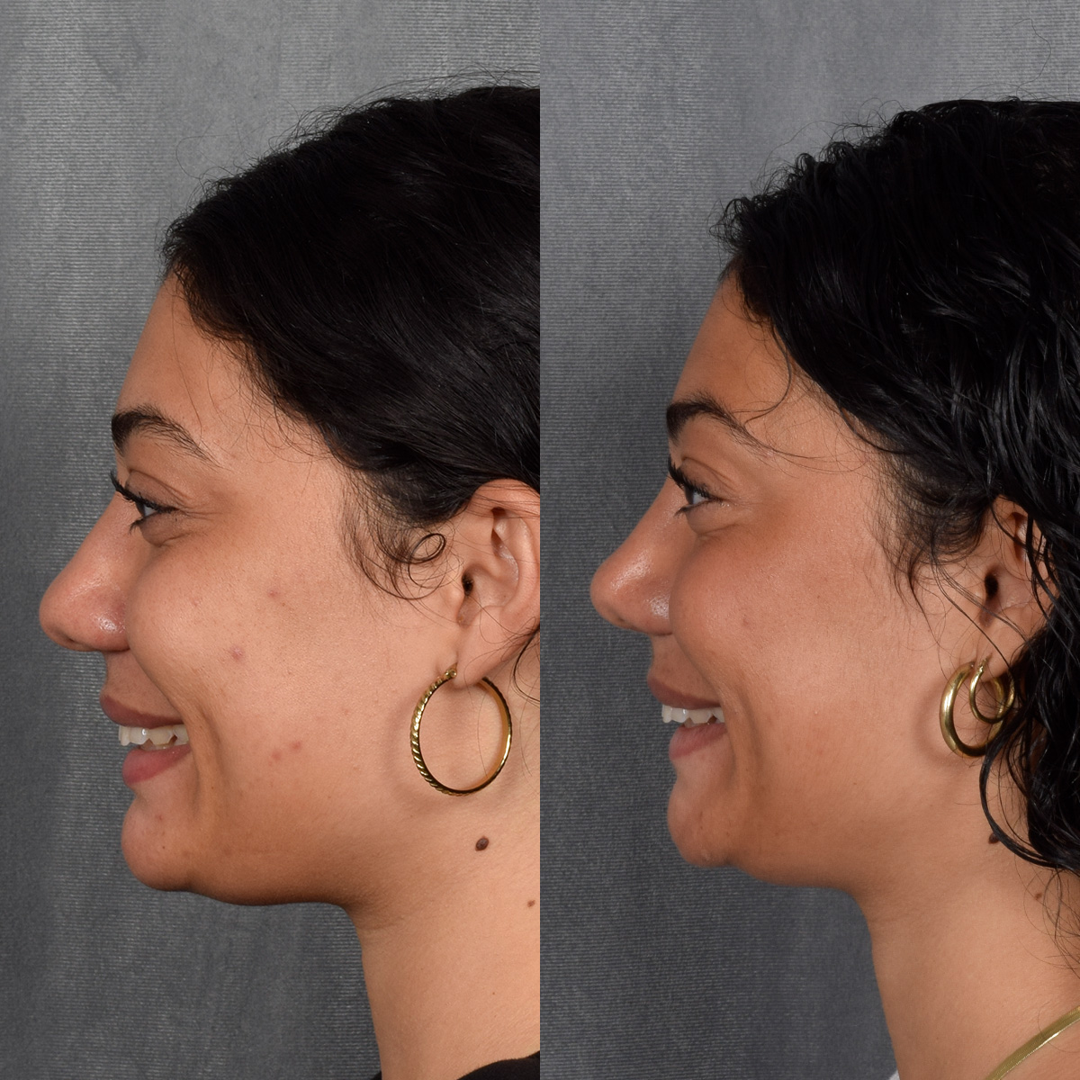 Rhinoplasty Before & After Gallery - Patient 258679 - Image 2