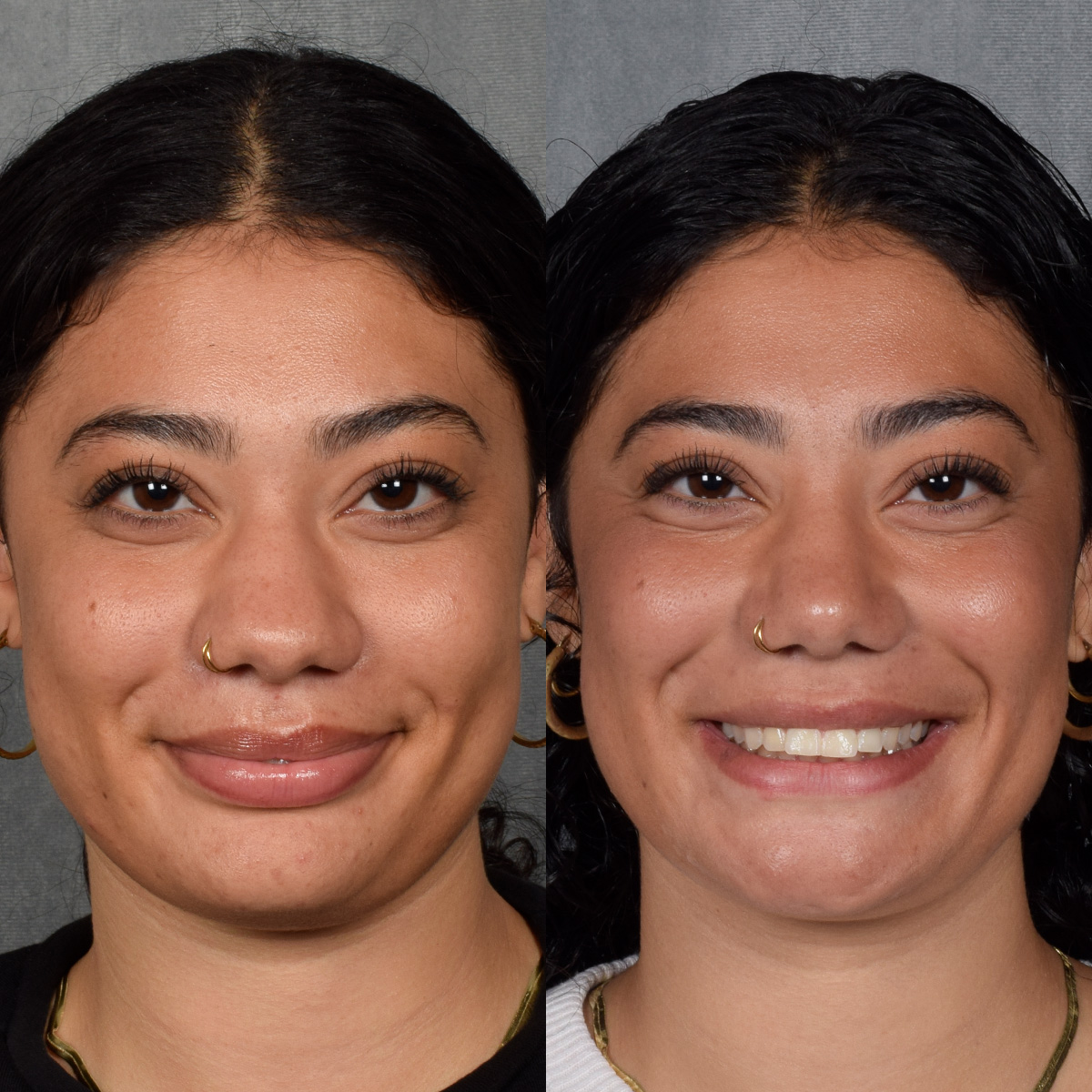 Rhinoplasty Before & After Gallery - Patient 258679 - Image 5