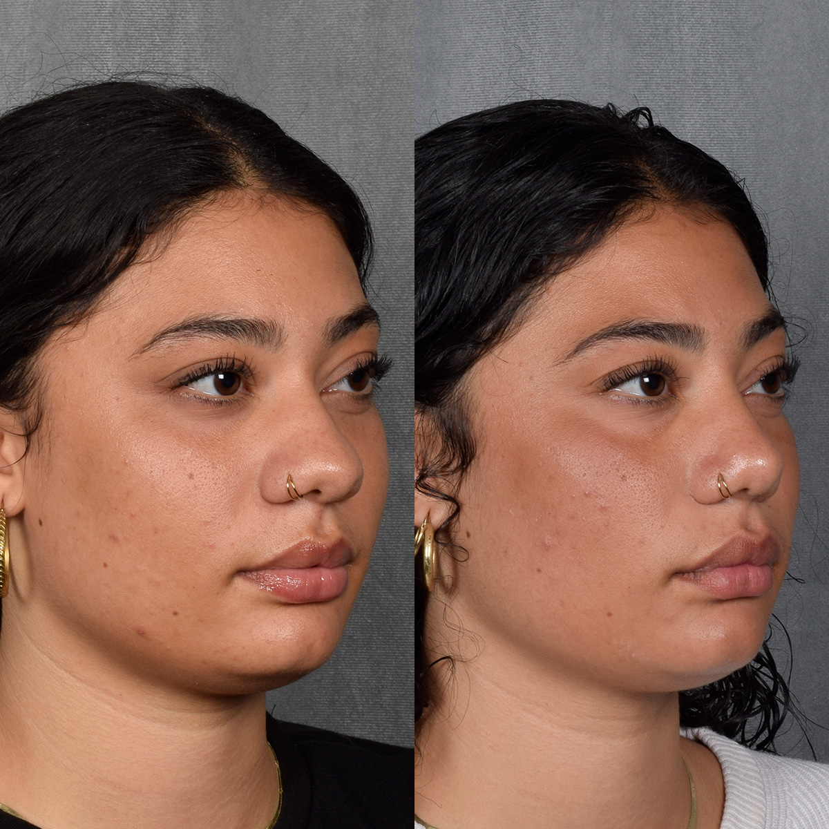 Rhinoplasty Before & After Gallery - Patient 258679 - Image 6