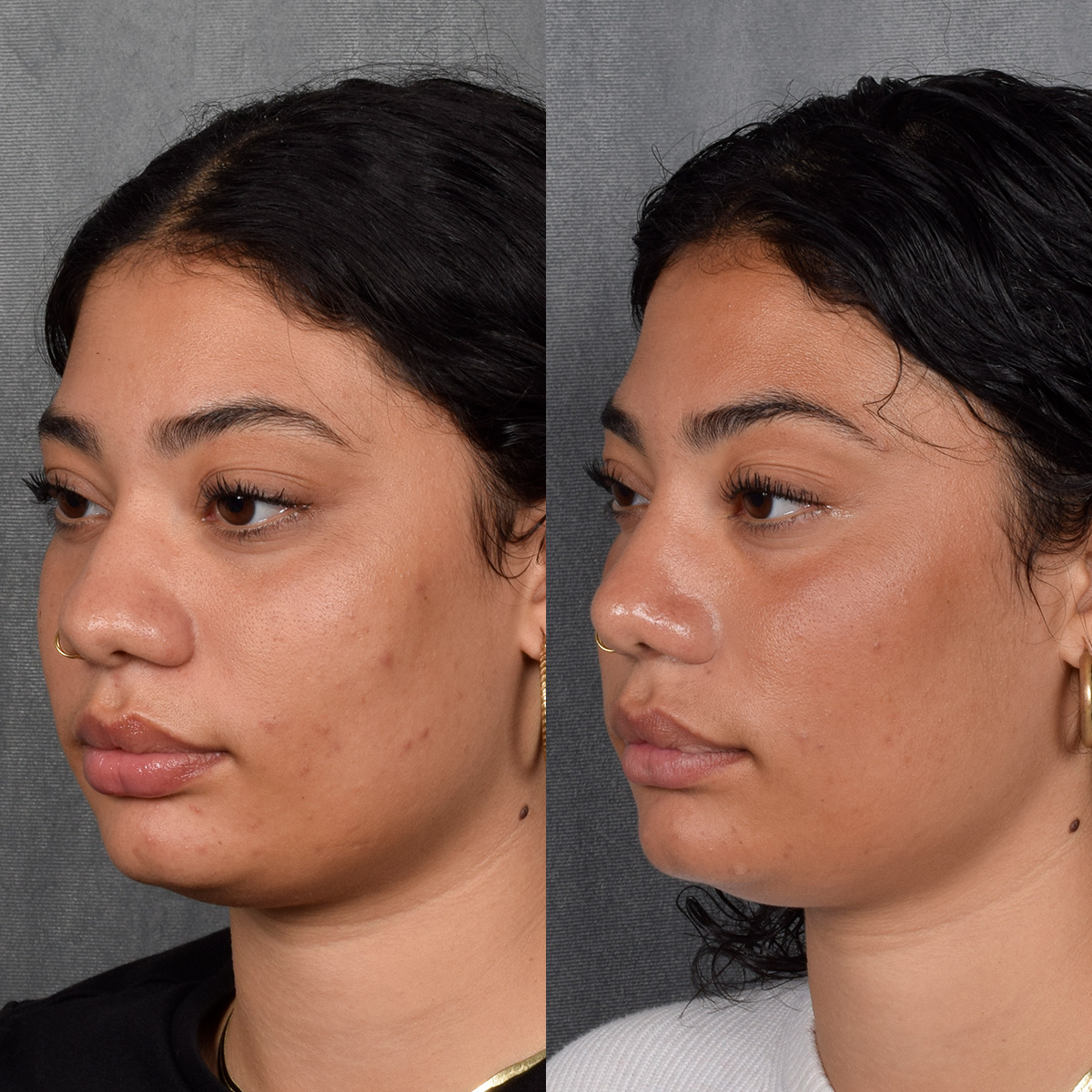 Rhinoplasty Before & After Gallery - Patient 258679 - Image 3
