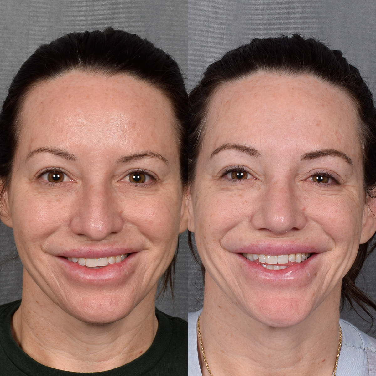 Rhinoplasty Before & After Gallery - Patient 428245 - Image 4