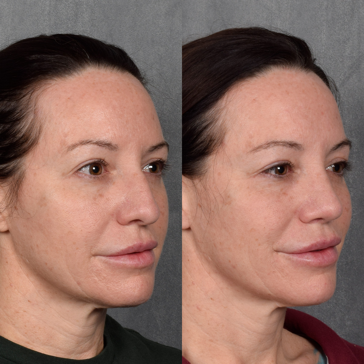 Rhinoplasty Before & After Gallery - Patient 428245 - Image 5