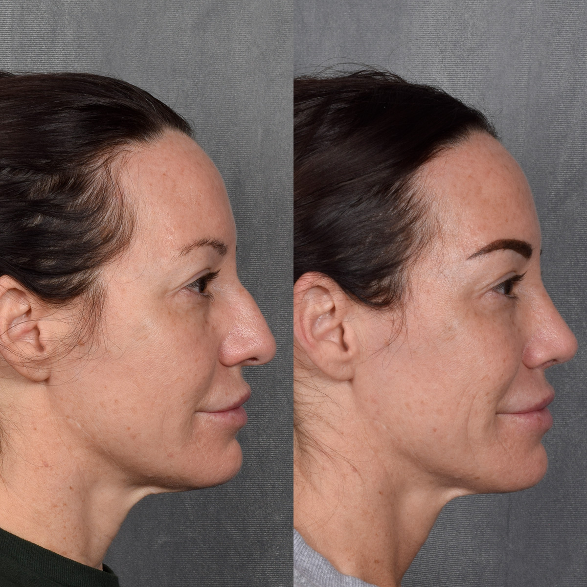 Rhinoplasty Before & After Gallery - Patient 428245 - Image 6