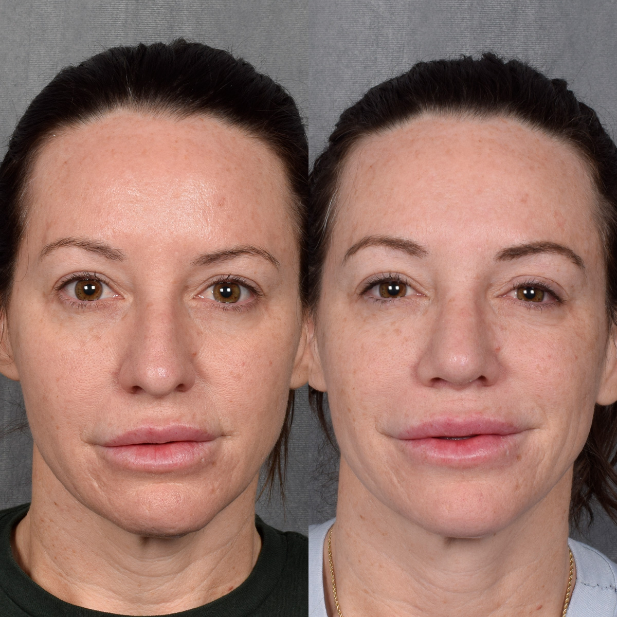 Rhinoplasty Before & After Gallery - Patient 428245 - Image 3