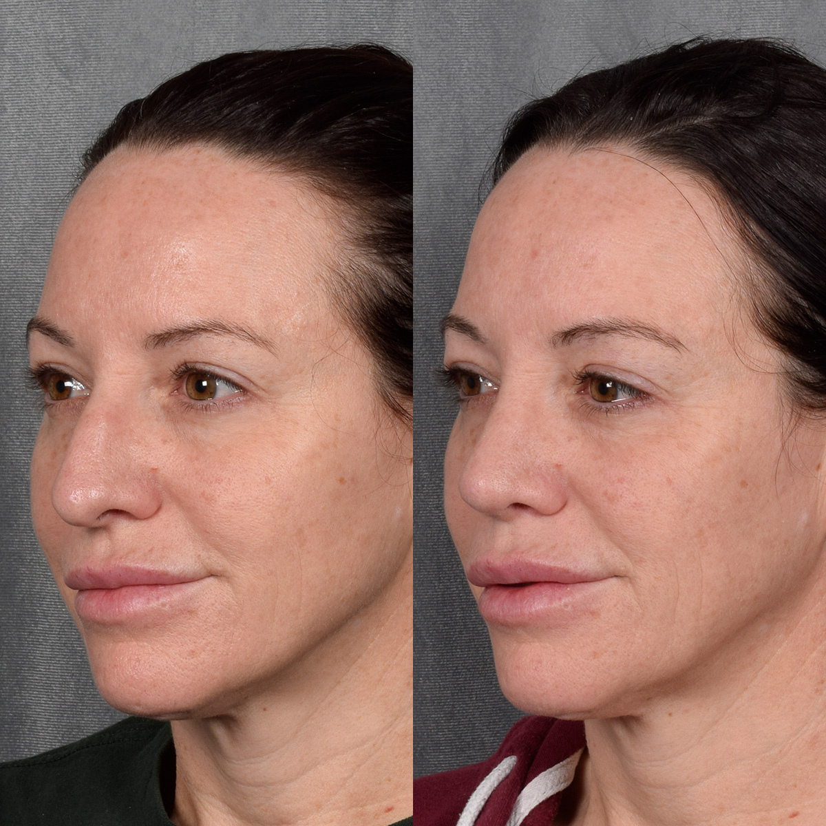 Rhinoplasty Before & After Gallery - Patient 428245 - Image 2