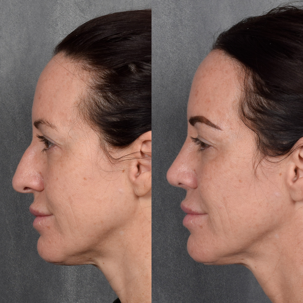 Rhinoplasty Before & After Gallery - Patient 428245 - Image 1