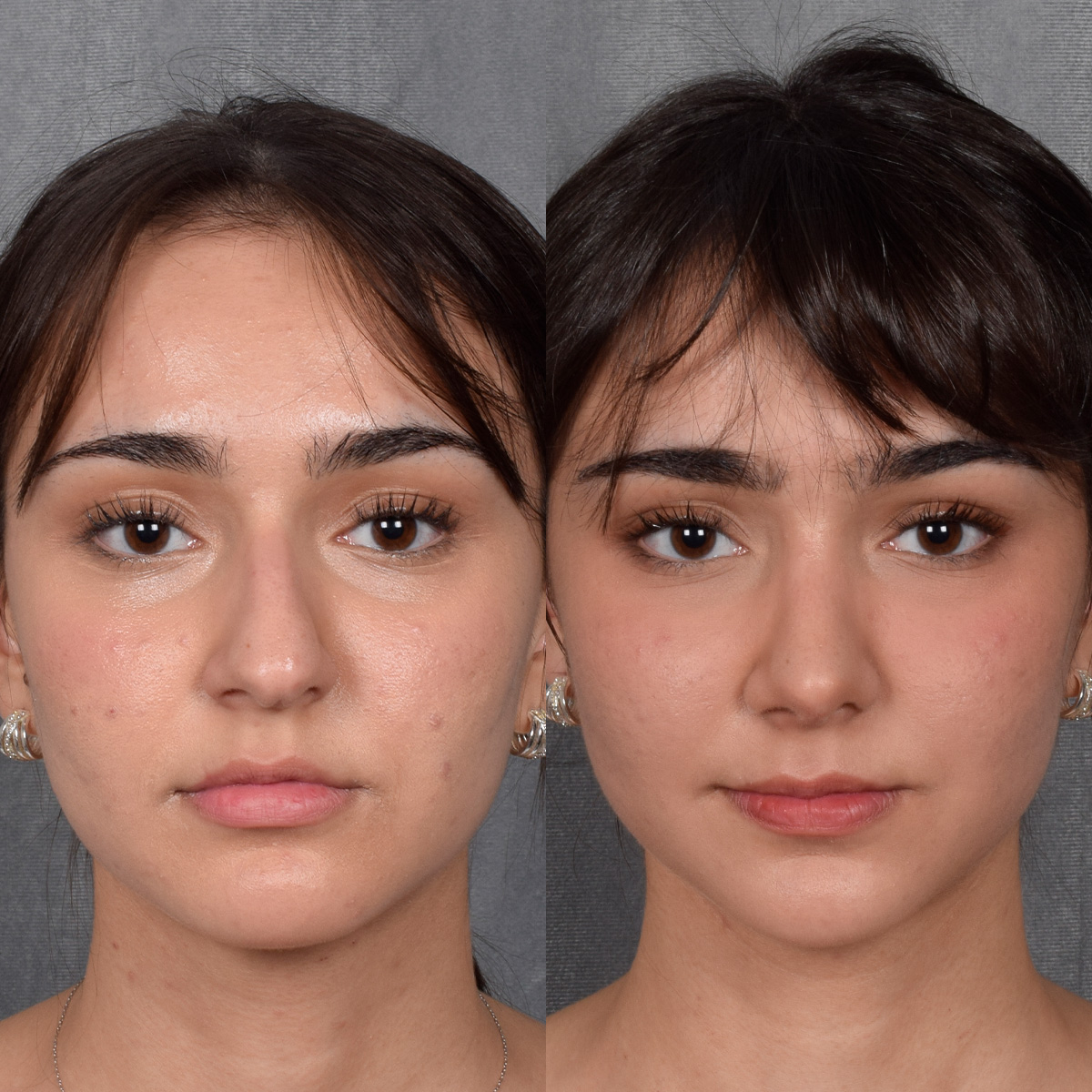 Rhinoplasty Before & After Gallery - Patient 692414 - Image 4