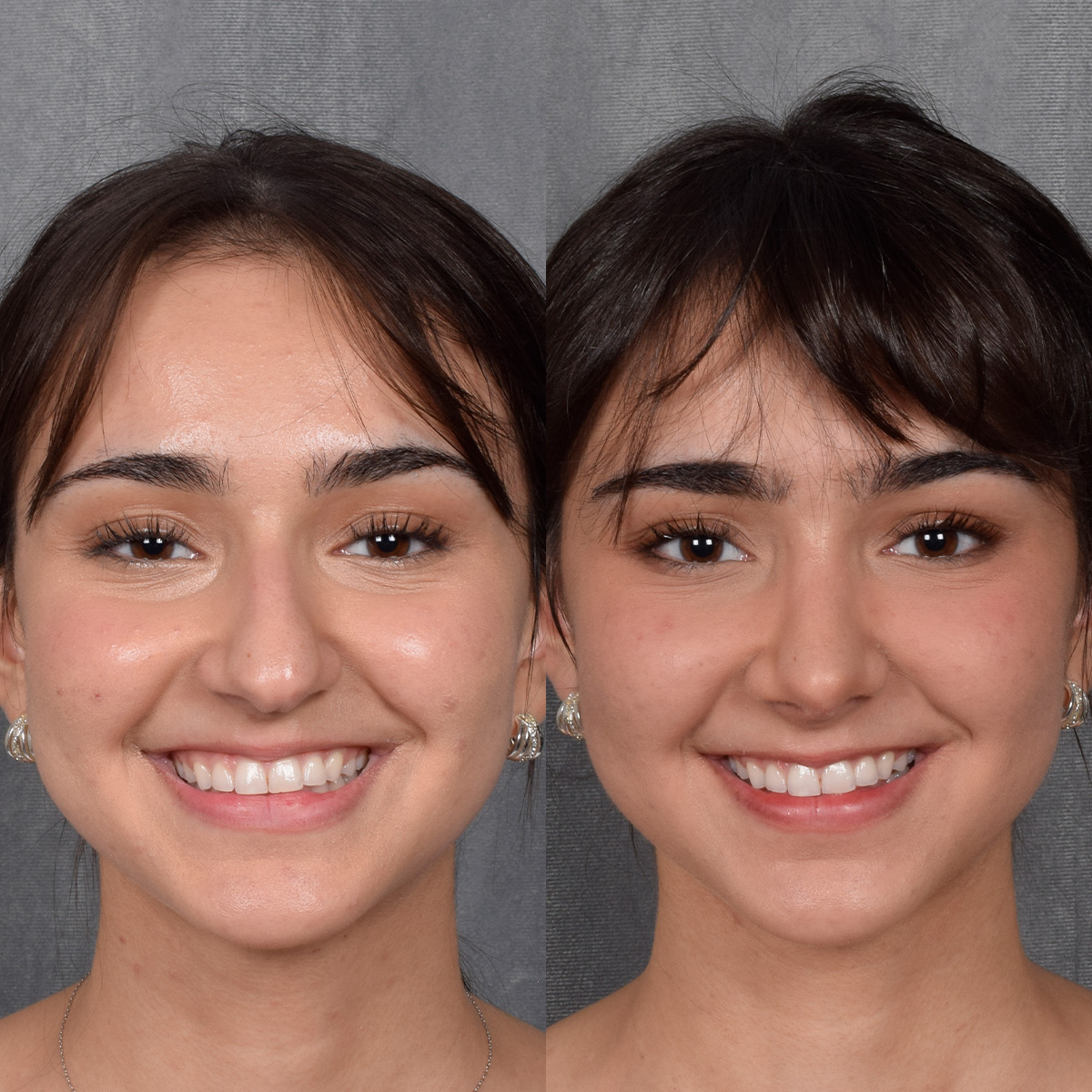 Rhinoplasty Before & After Gallery - Patient 692414 - Image 5