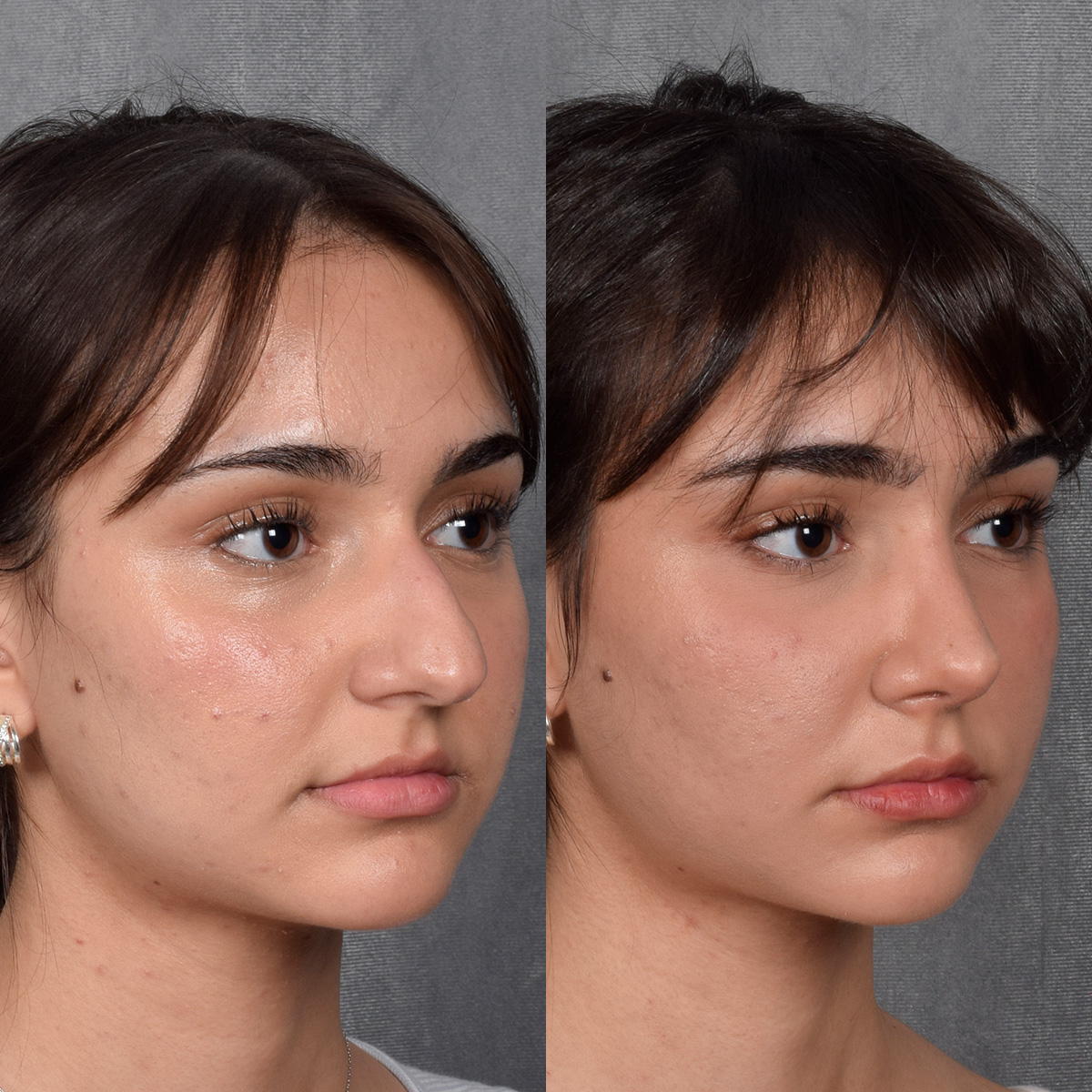 Rhinoplasty Before & After Gallery - Patient 692414 - Image 6