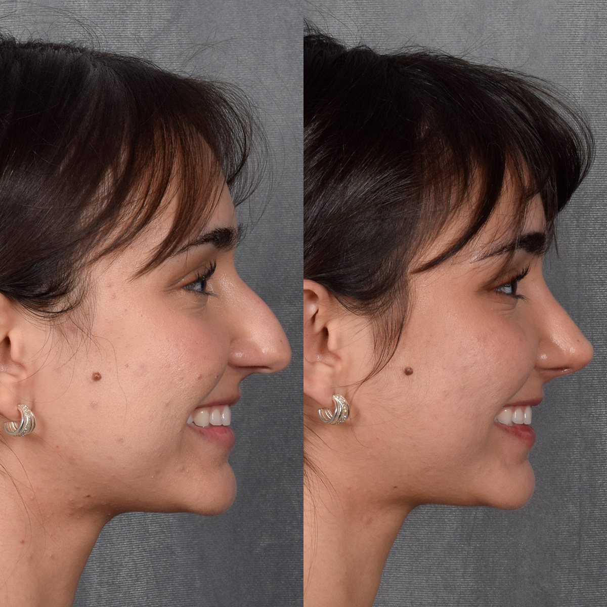 Rhinoplasty Before & After Gallery - Patient 692414 - Image 8